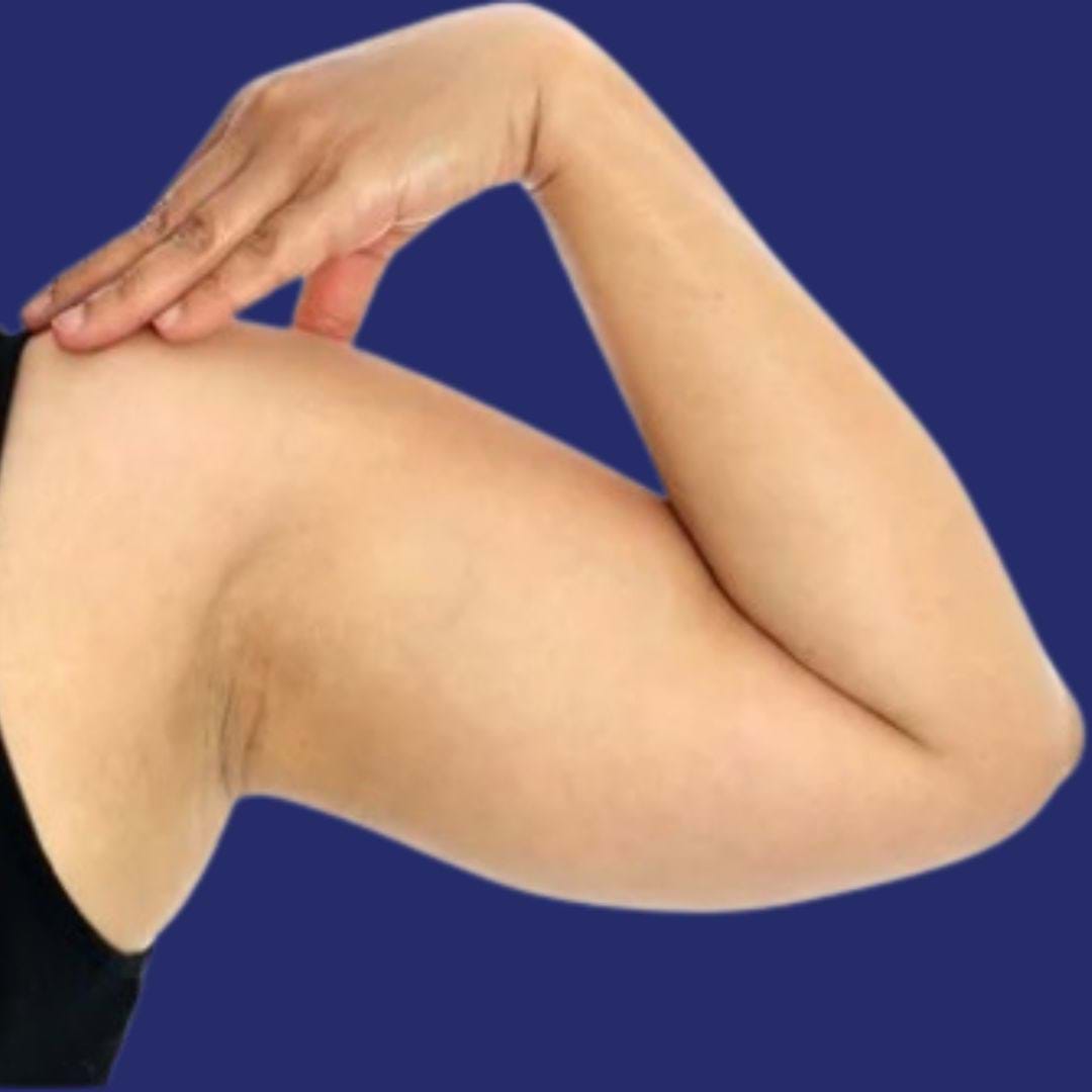 Imagen de la zona de los brazos antes del procedimiento de liposucción.