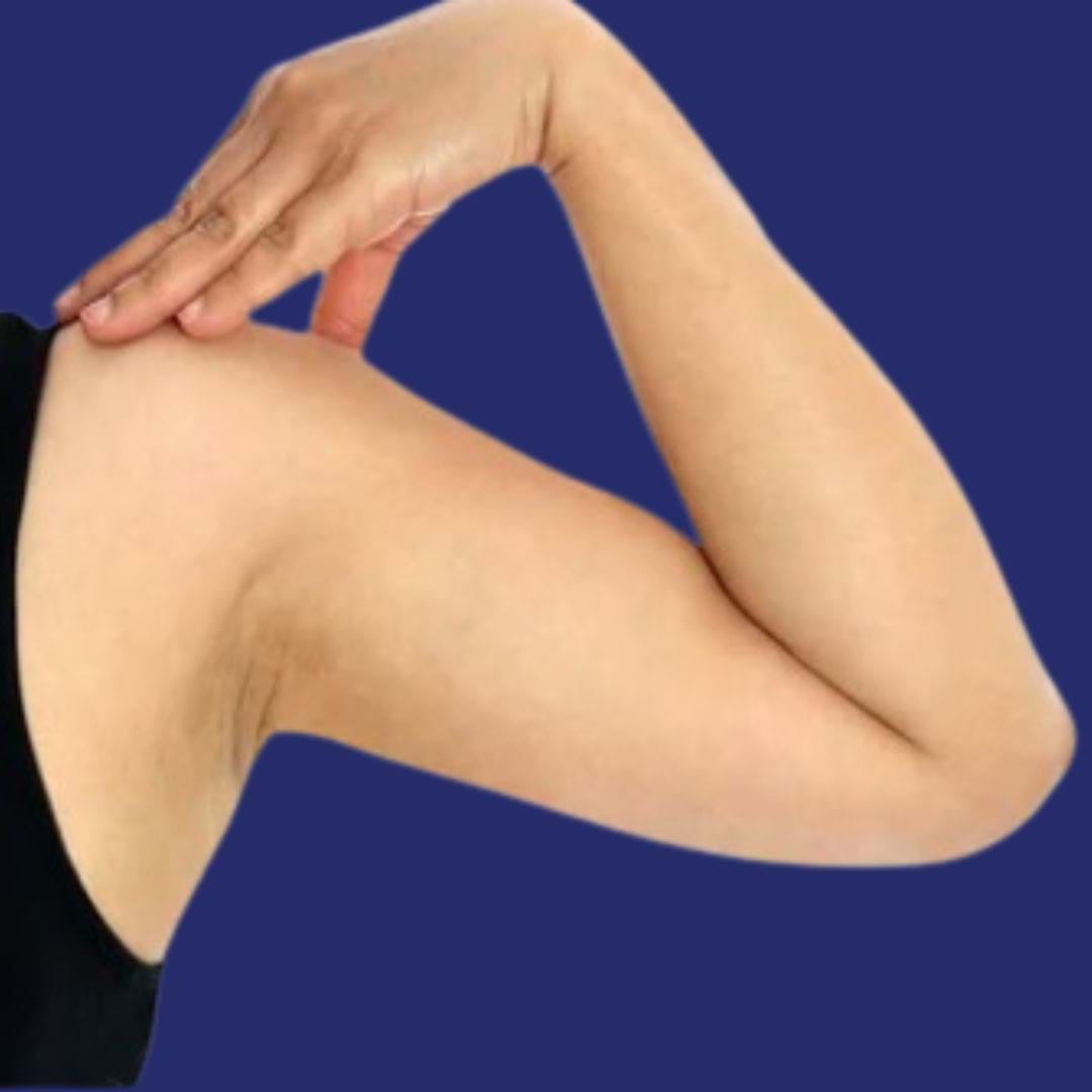 Imagen de la zona de los brazos tratada después del procedimiento de liposucción.