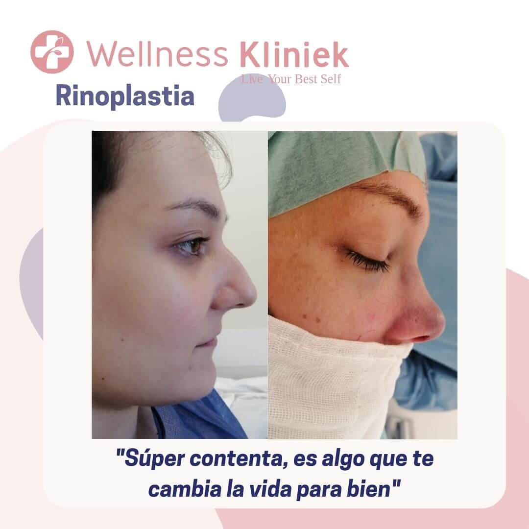 Rinoplastia realizada por el Dr. Carlos Beltrán 