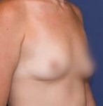 Antes