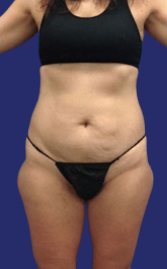 Antes de una liposucción