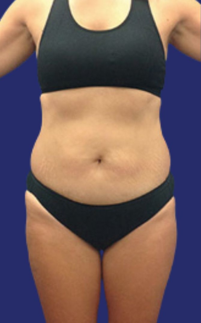 Después de una liposucción