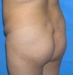 Before liposculpting the butt