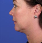 Before Neck Correction