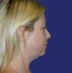 Before Double Chin Liposculpture