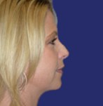 After Double Chin Liposculpture