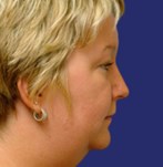 Antes de una cirugía del doble mentón