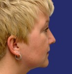 Después de una cirugía del doble mentón