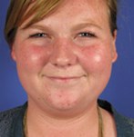 Antes de una corrección del doble mentón