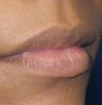 Después de una reducción de labios