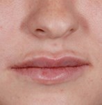 After Lip Enlargement