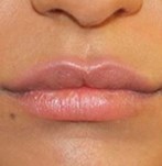 Después de un aumento de labios con grasa propia