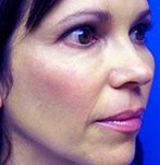 Después de un lifting facial vampiro