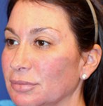 Después de un lifting facial vampiro PRP