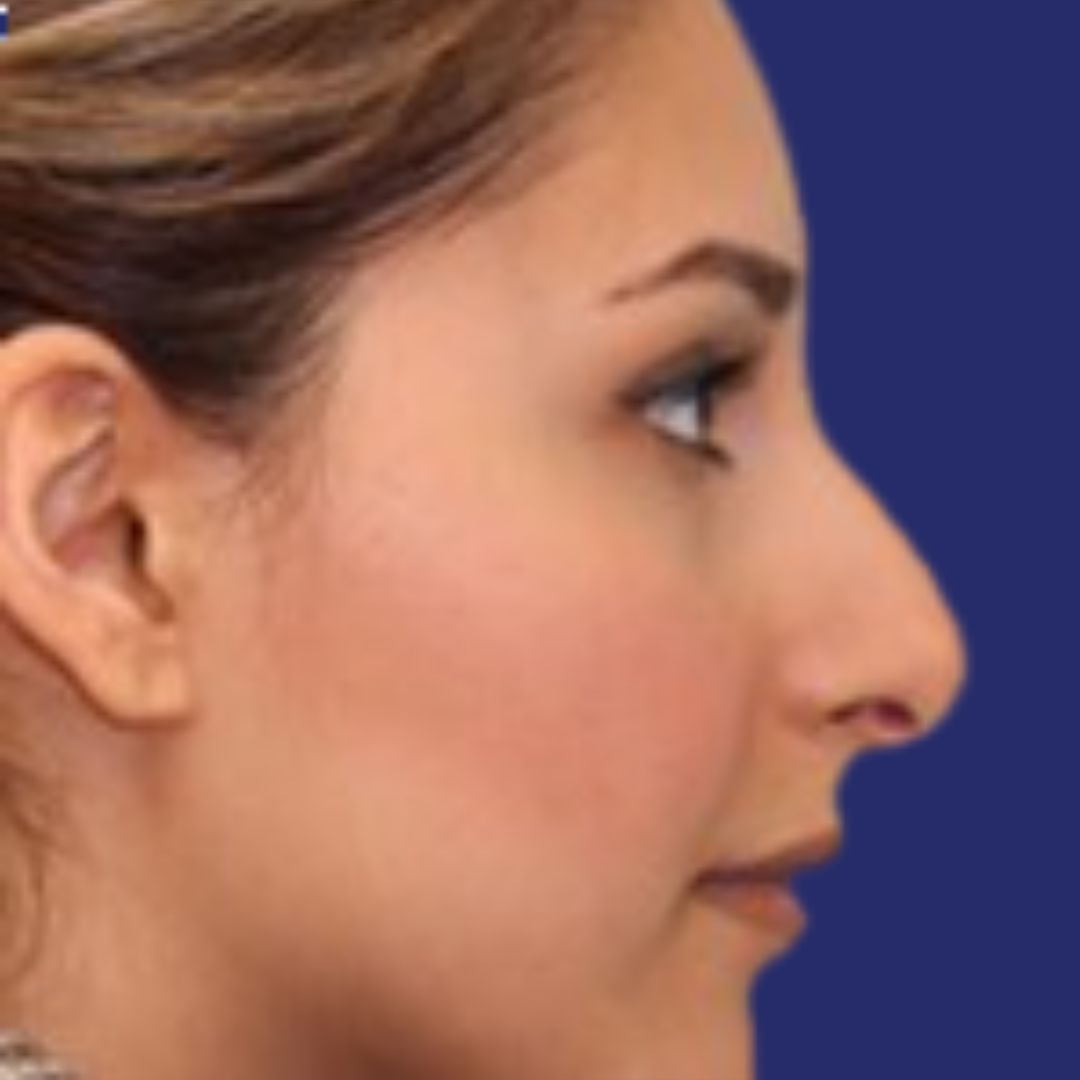 Face before rhinoplasty showing prominent nasal bridge
