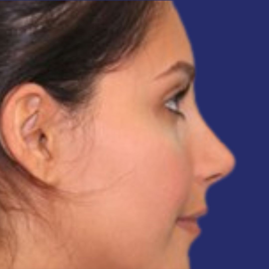 Result after rhinoplasty with smoother, balanced nasal bridge