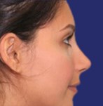 Resultado tras rinoplastia con puente nasal más suave y equilibrado