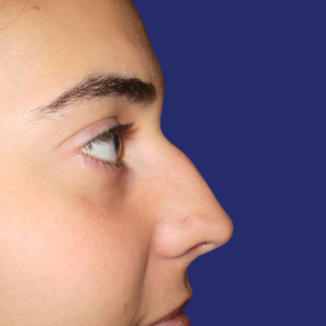 Before correcting nose tip and bridge
