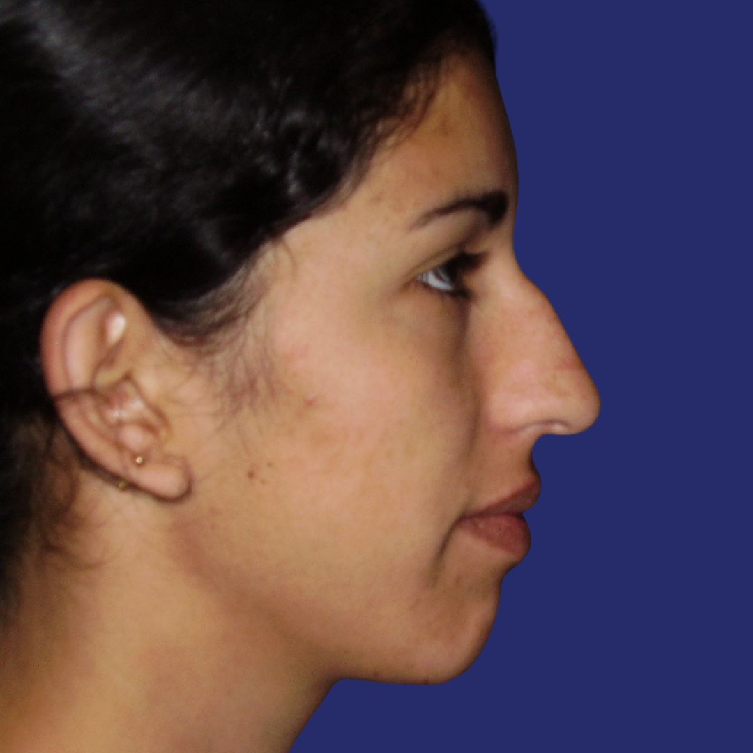 Before refining the nose tip and correction nose bridge