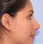 After refining nose tip and correcting nose bridge