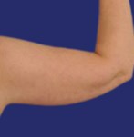 Before Arm Lipo