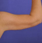 Después de una liposucción de los brazos