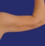 After Arm Lipo