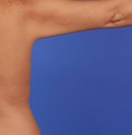 Después de una liposucción de brazos