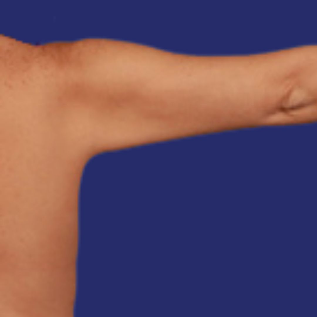 After Arm Lipo