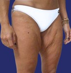 Before thighplasty: removal of excess skin from the upper legs.