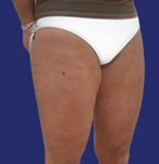 After Thighlift combined with Circumferential Body Lift and Breast lift