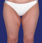 Before Lifting of Thighs