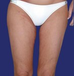 After lifting of Inner Thighs and skin of the upper Legs