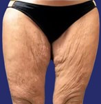 Before removal of excess skin upper legs with Thigh Lift