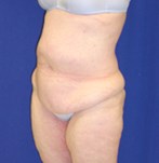 Antes de la eliminación del exceso de piel de la parte superior de las piernas combinado con un lifting corporal