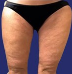 After removal of excess skin upper legs Thigh Lift