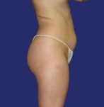 Before Liposuction under the navel