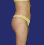 After liposuction under the navel