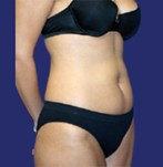 Antes de una liposucción de abdomen