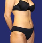 Después de una liposucción de abdomen