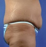 Antes de una abdominoplastia