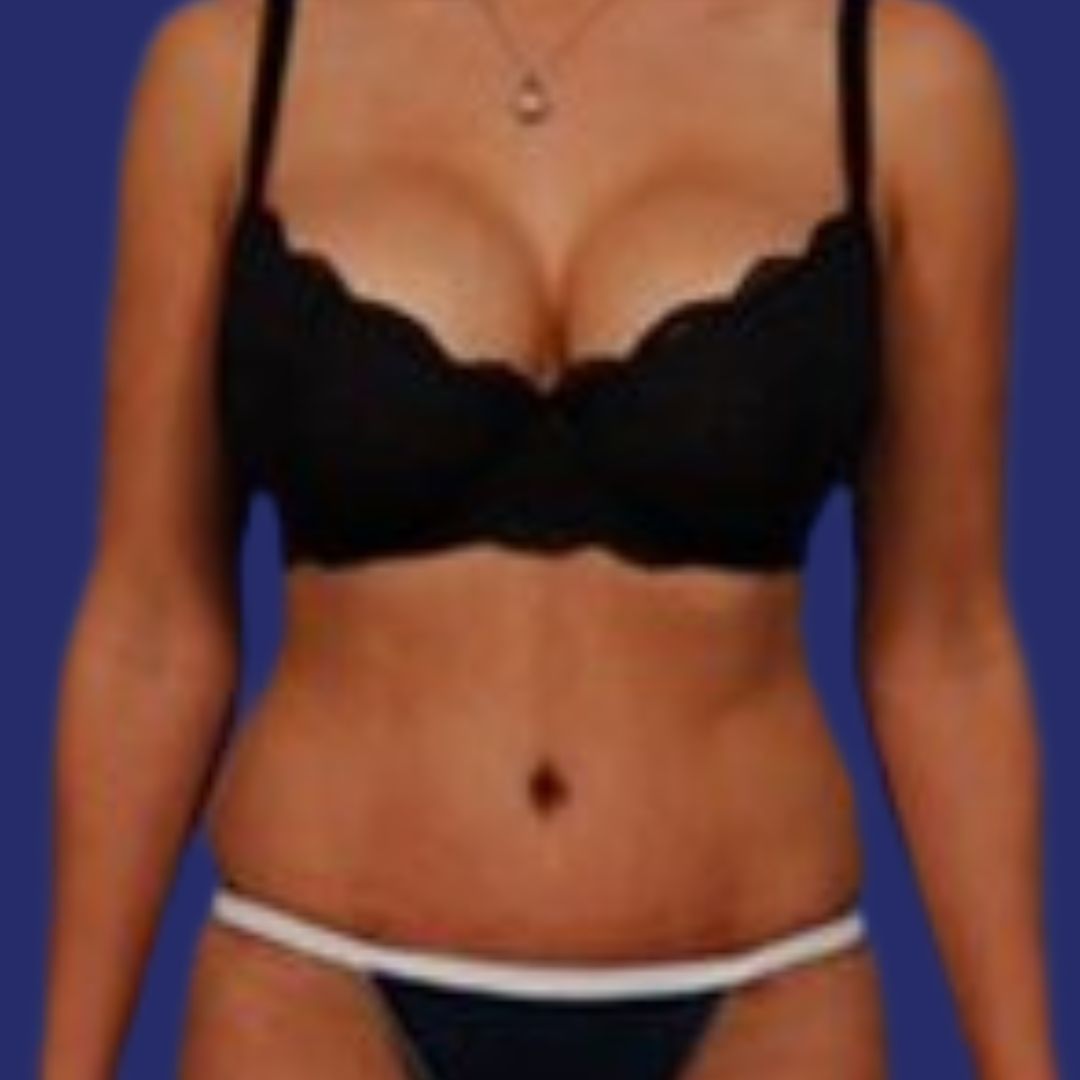 Después de abdominoplastia para lograr un abdomen más firme y estético