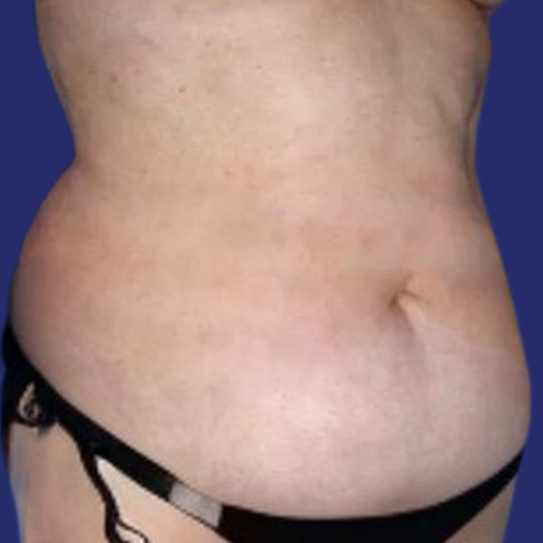 Antes de abdominoplastia en abdomen post embarazo