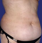 Results tummy tuck photos