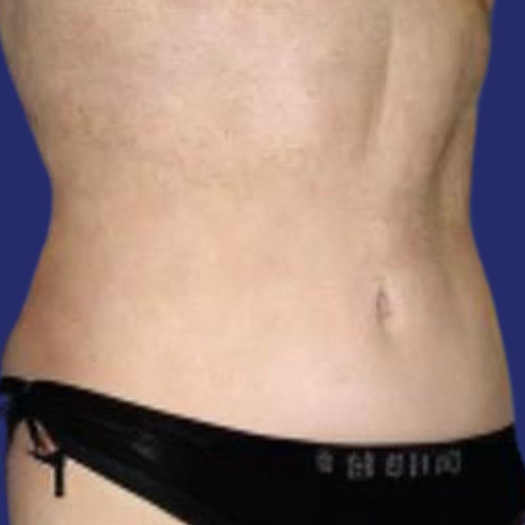 Resultado de mini abdominoplastia post embarazo con vientre plano 