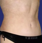 Result of post-pregnancy abdominoplasty with a flat belly