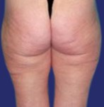 Before liposuction of the buttocks