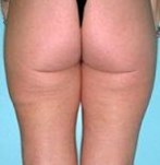 After liposuction of the buttocks