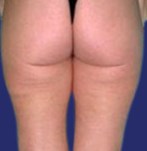 After liposuction of the buttocks