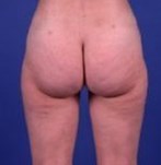 After liposuction of the buttocks